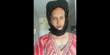 Transgender Trailblazer Jolene Dawson Unveils ,000 Head Implant Procedure, Redefining Self-Expression and Identity